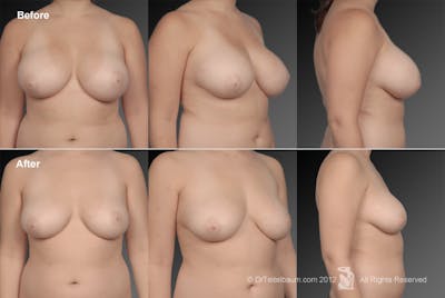 Breast Reduction Before & After Gallery - Patient 105470072 - Image 1