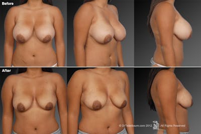 Breast Reduction Before & After Gallery - Patient 105470079 - Image 1