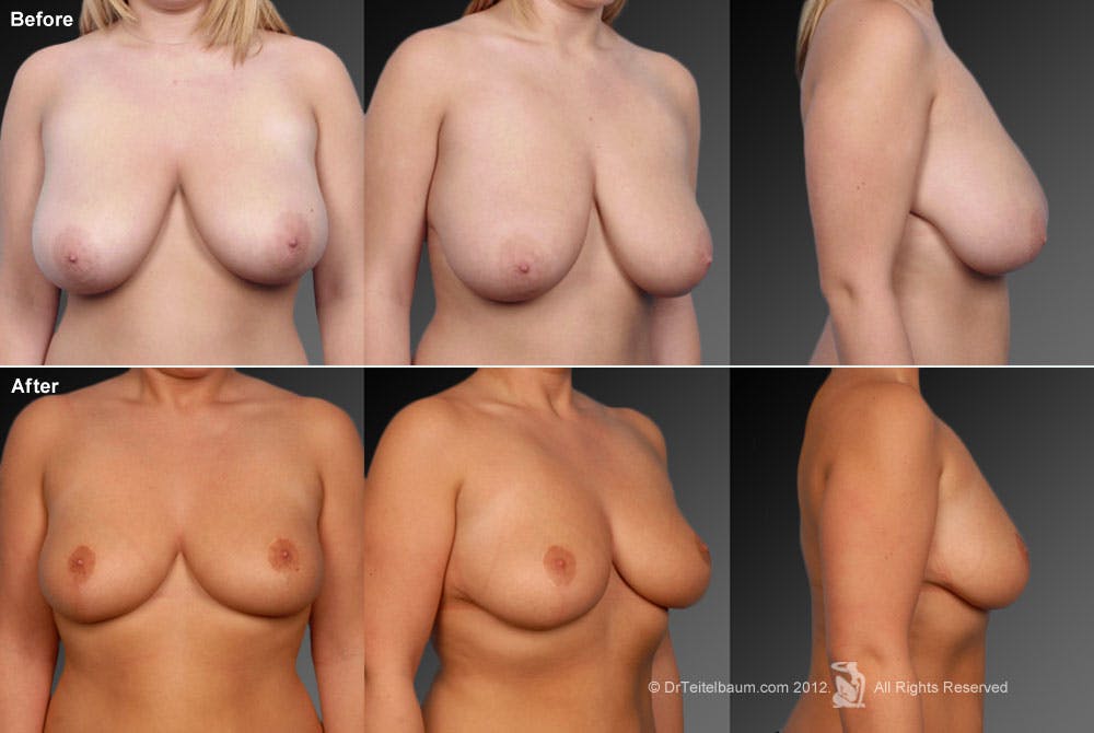Breast Reduction Before & After Gallery - Patient 105470088 - Image 1