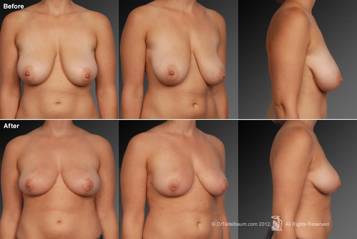 Breast Reduction Before & After Gallery - Patient 105470094 - Image 1