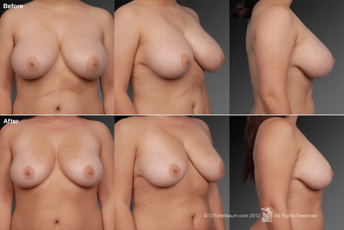 Breast Reduction Before & After Gallery - Patient 105470095 - Image 1