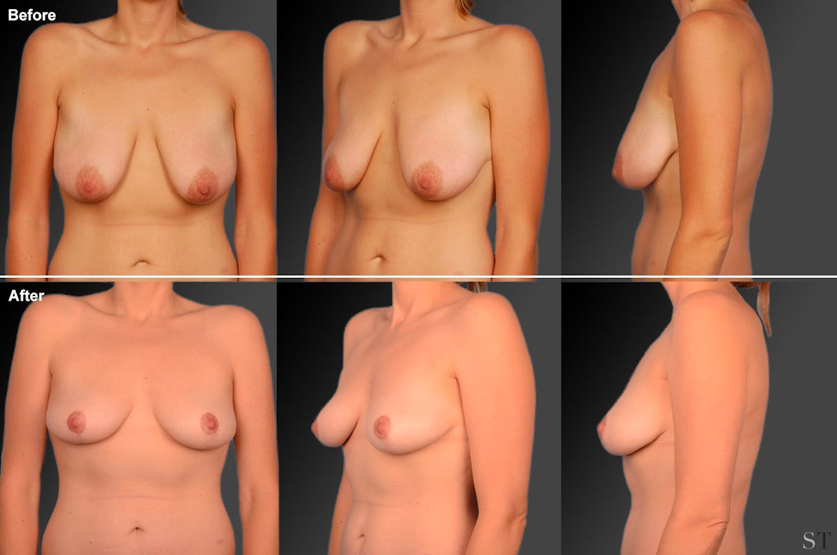 Breast Reduction Before & After Gallery - Patient 105470108 - Image 1
