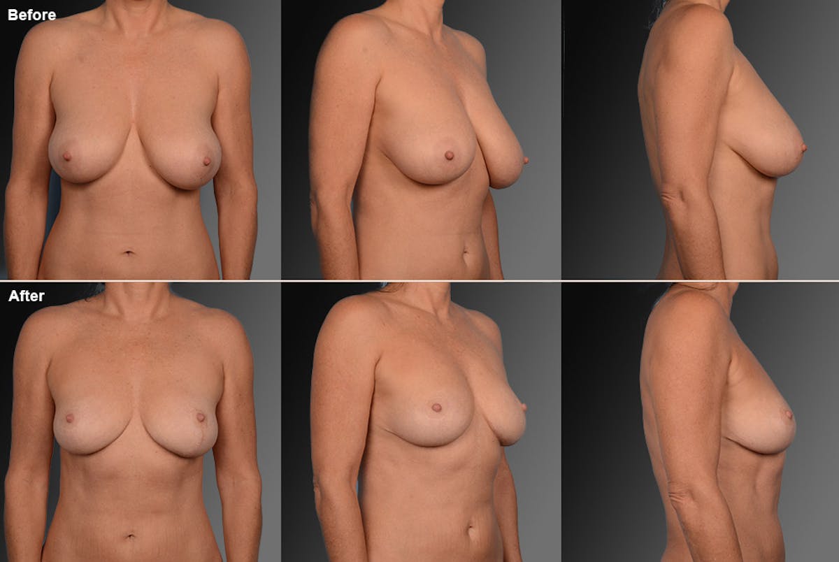 Breast Reduction Before & After Gallery - Patient 105470110 - Image 1