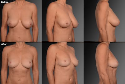 Breast Reduction Before & After Gallery - Patient 105470110 - Image 1