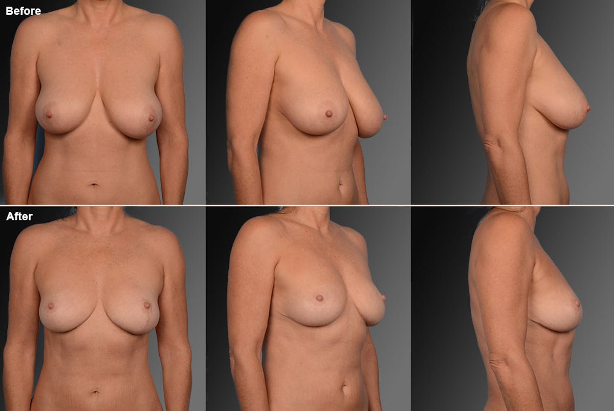 Breast Reduction Before & After Gallery - Patient 105470110 - Image 1