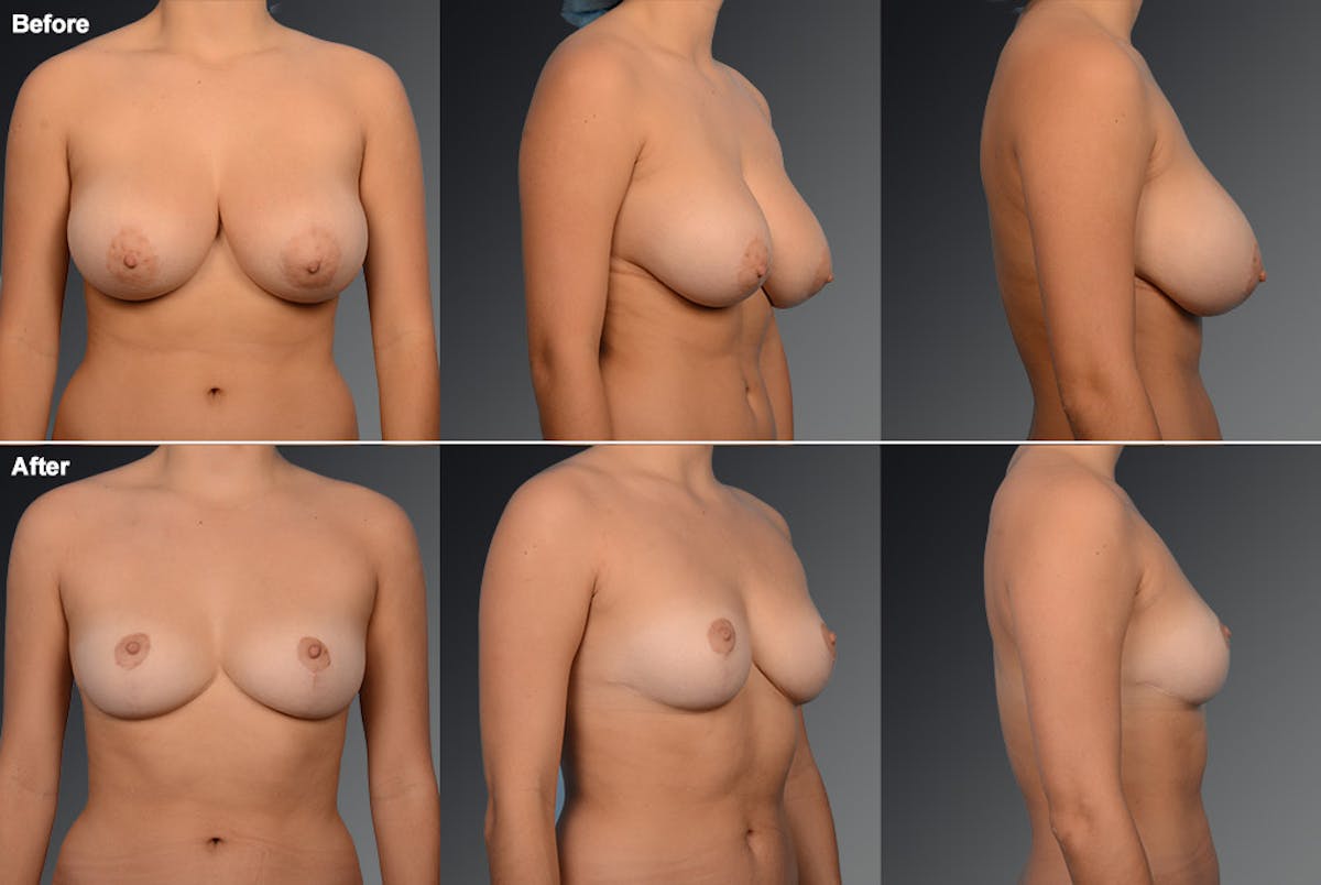 Breast Reduction Before & After Gallery - Patient 105470111 - Image 1