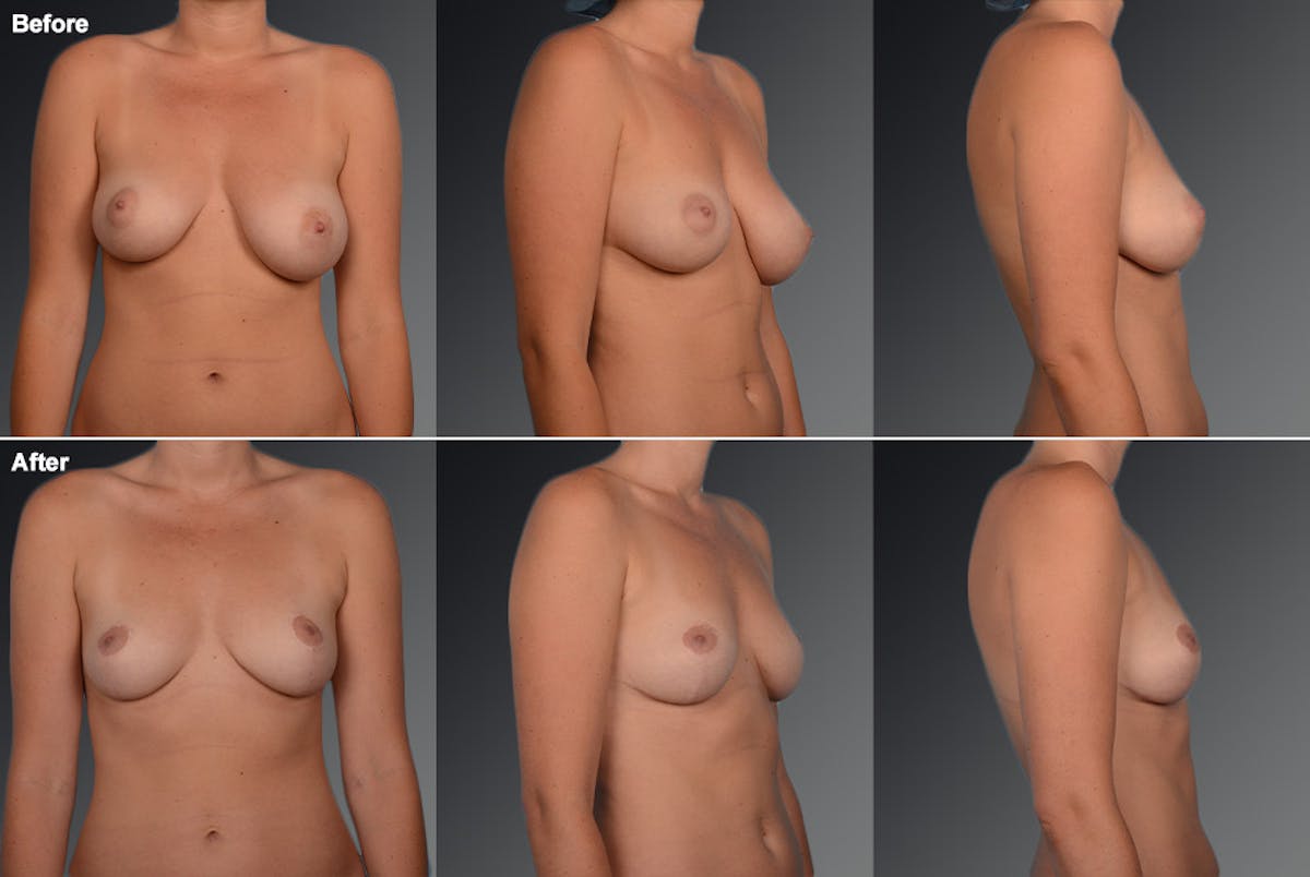 Breast Reduction Before & After Gallery - Patient 105470113 - Image 1