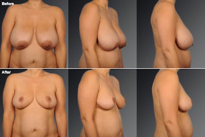 Breast Reduction Before & After Gallery - Patient 105470116 - Image 1