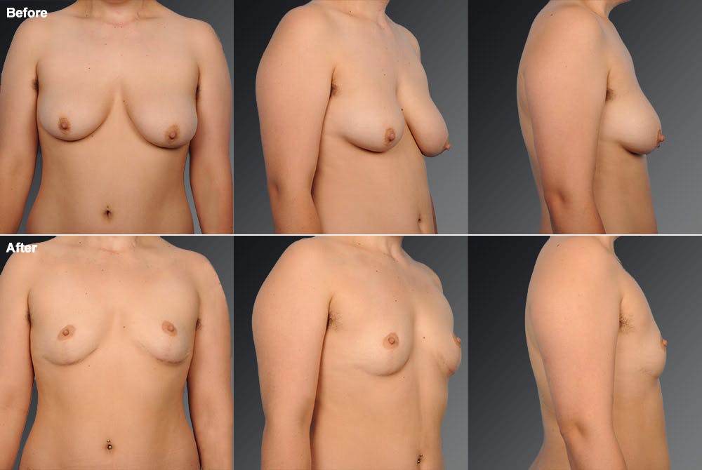 Breast Reduction Before & After Gallery - Patient 105470119 - Image 1
