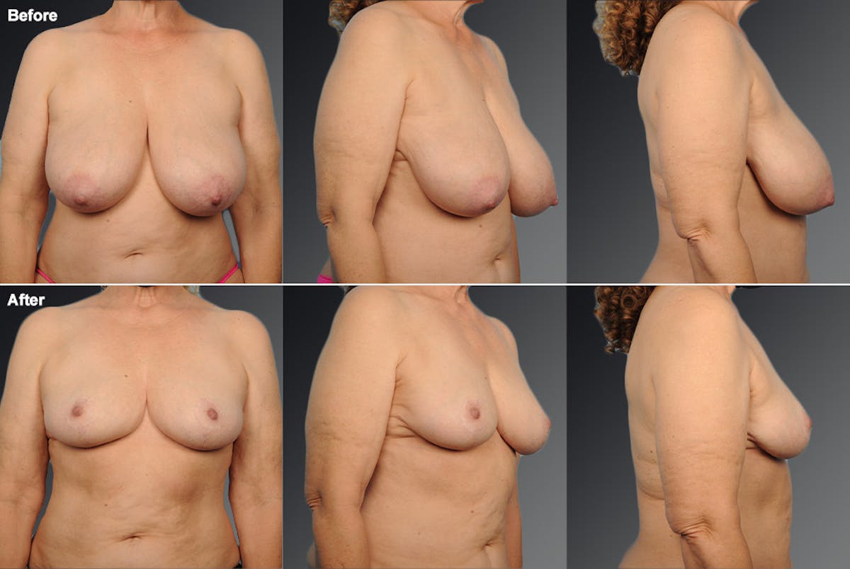 Breast Reduction Before & After Gallery - Patient 105470121 - Image 1