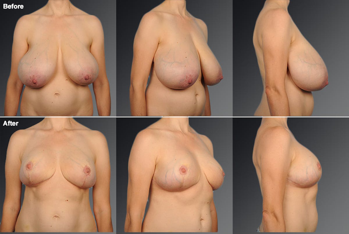 Breast Reduction Before & After Gallery - Patient 105470123 - Image 1