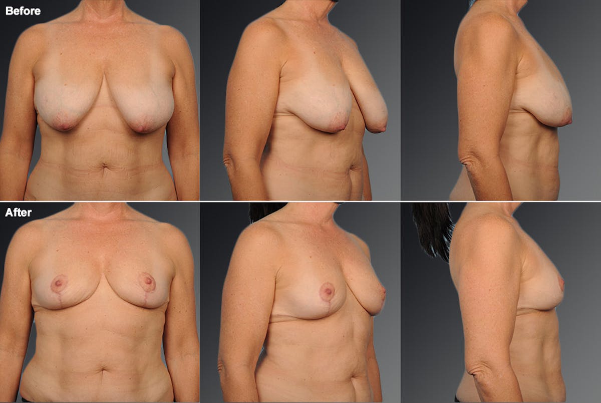 Breast Reduction Before & After Gallery - Patient 105470124 - Image 1