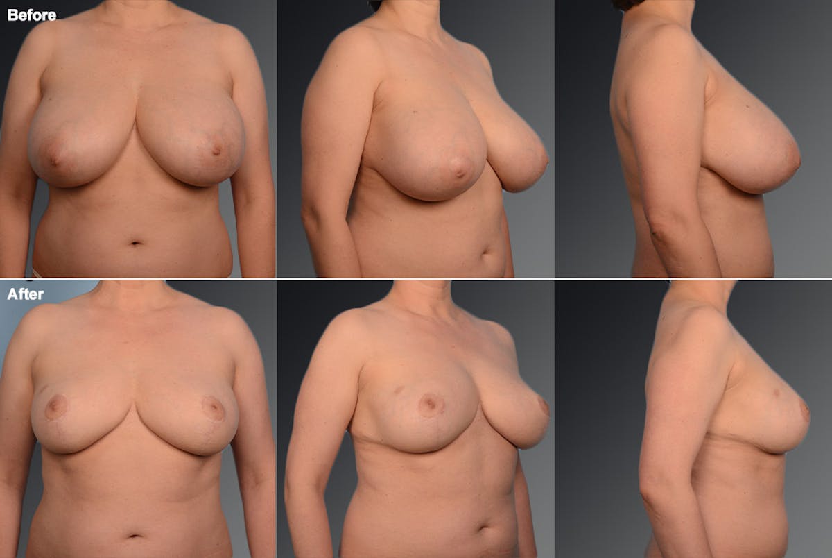 Breast Reduction Before & After Gallery - Patient 105470125 - Image 1