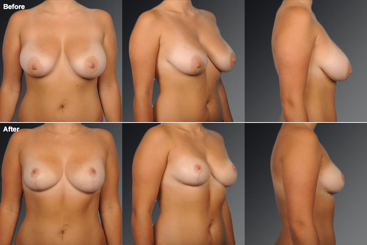 Breast Reduction Before & After Gallery - Patient 105470126 - Image 1