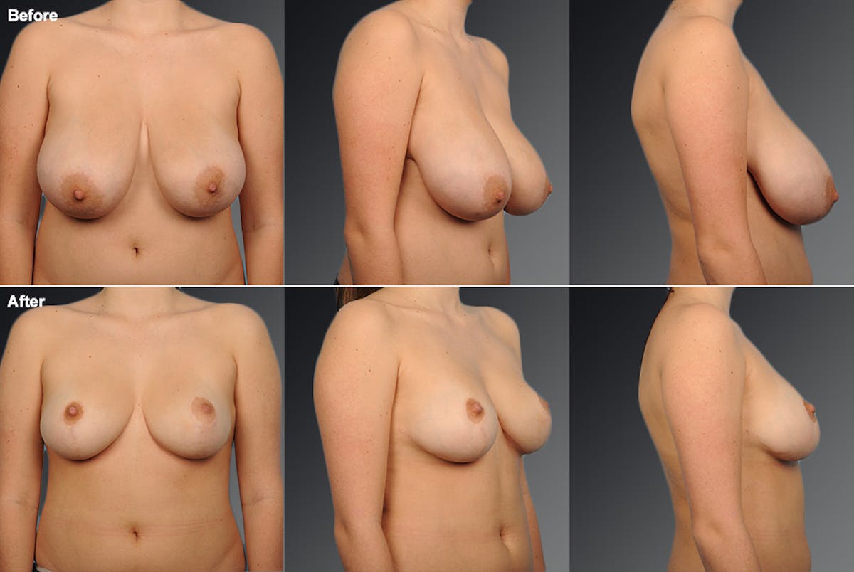 Breast Reduction Before & After Gallery - Patient 105470128 - Image 1
