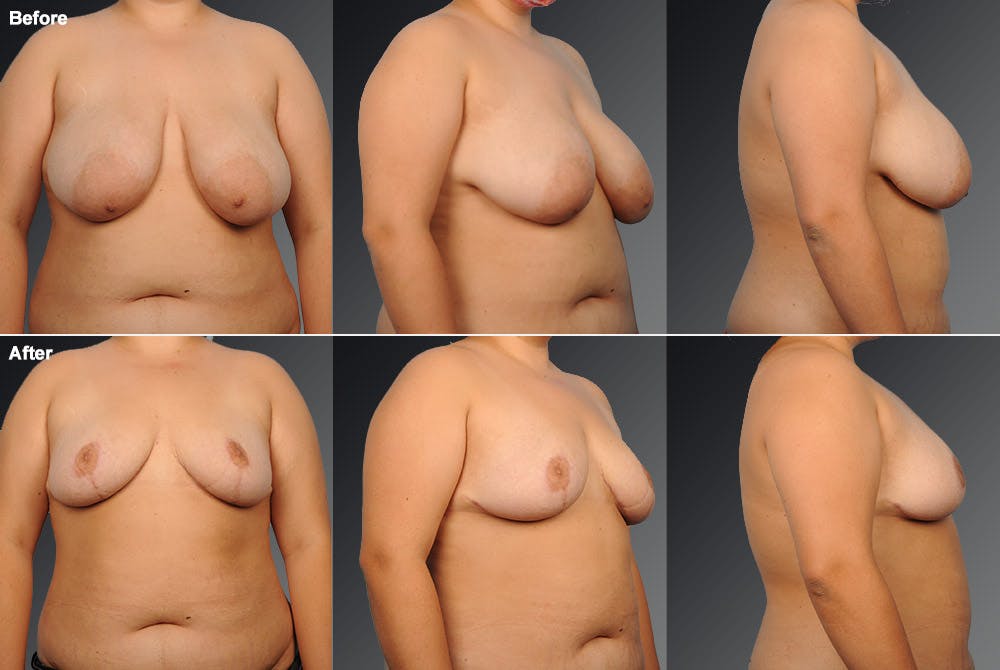 Breast Reduction Before & After Gallery - Patient 105470129 - Image 1