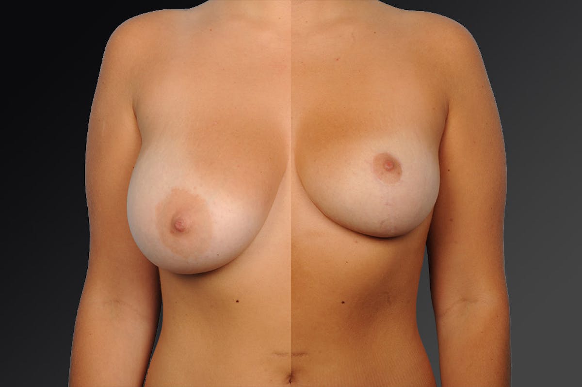 Breast Reduction Before & After Gallery - Patient 105470130 - Image 1