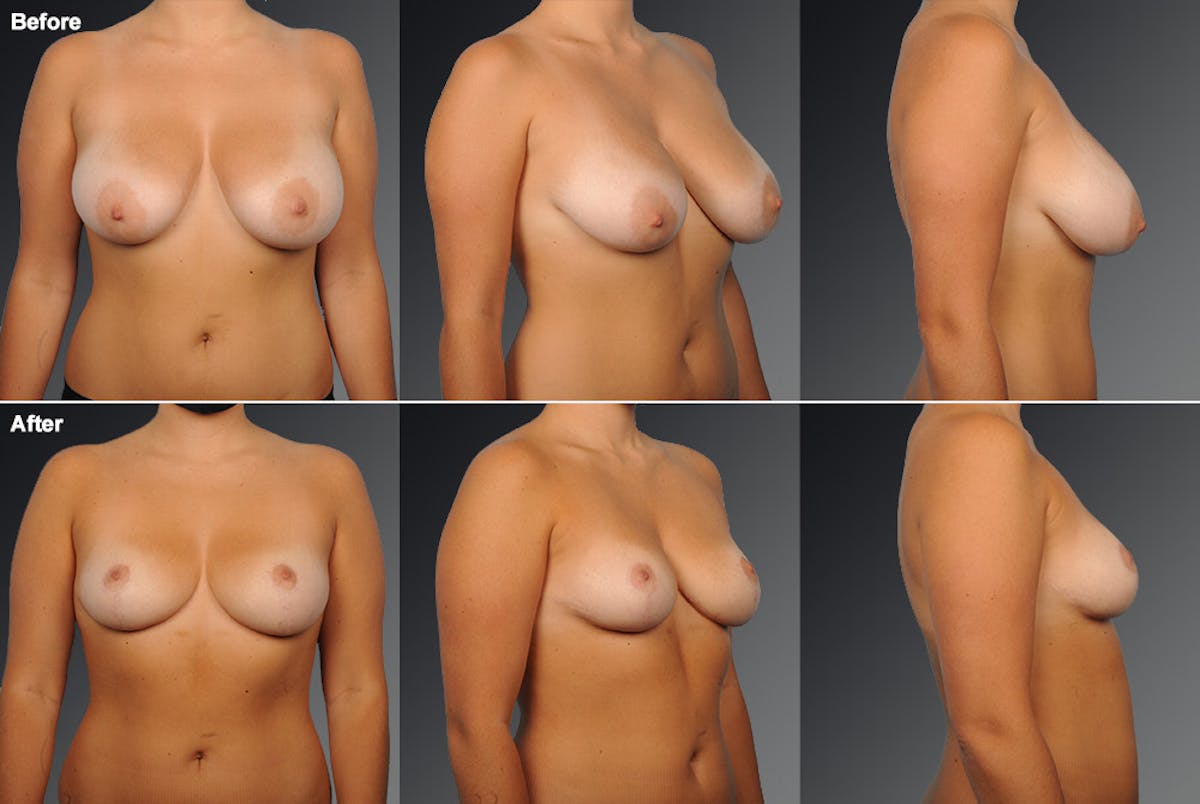 Breast Reduction Before & After Gallery - Patient 105470131 - Image 1