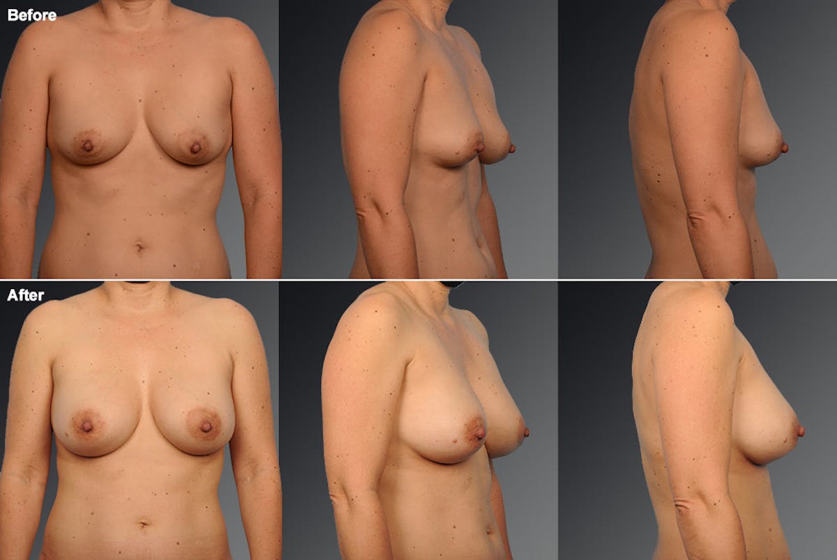 Breast Reduction Before & After Gallery - Patient 105470134 - Image 1