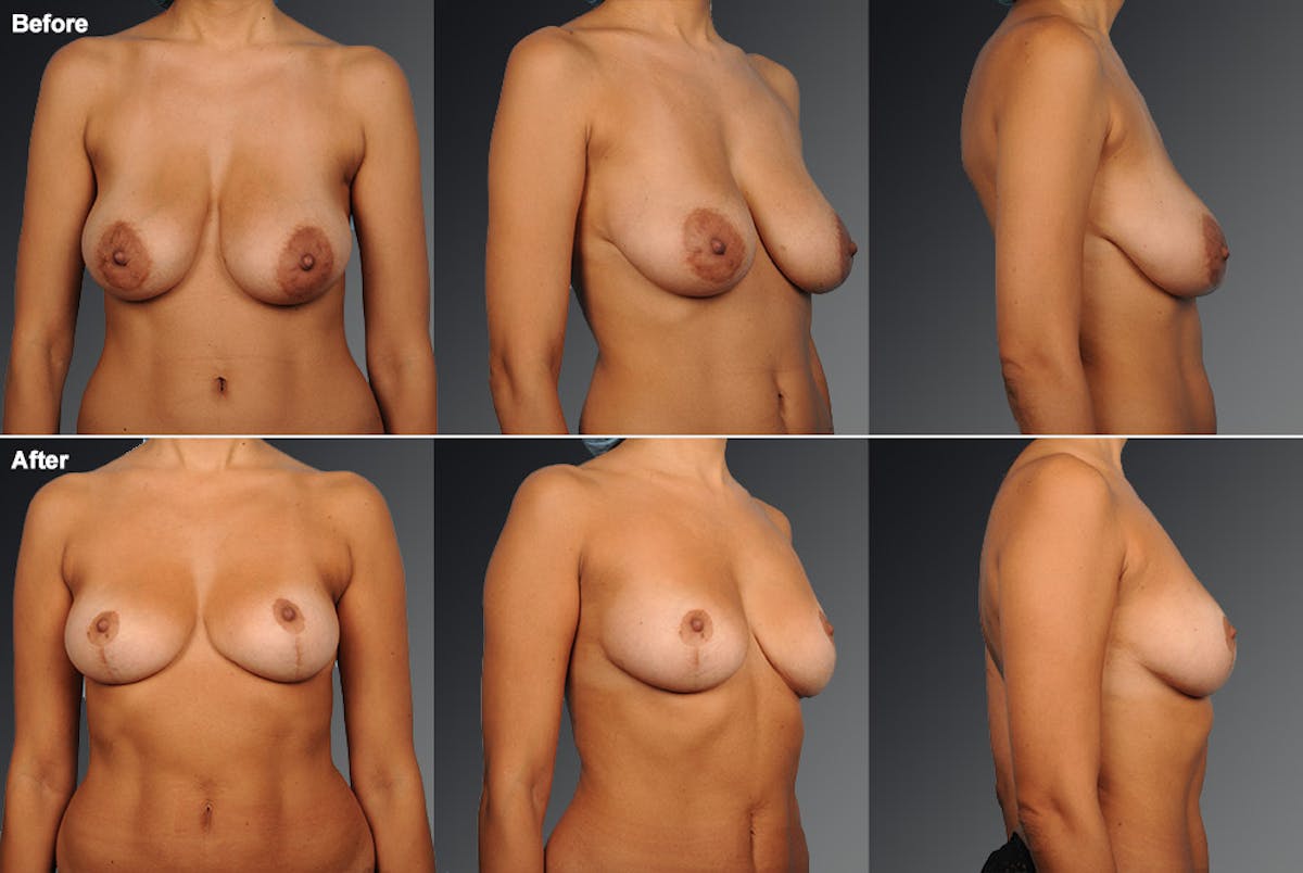 Breast Reduction Before & After Gallery - Patient 105470136 - Image 1