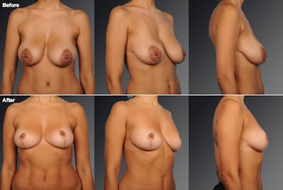 Breast Reduction Before & After Gallery - Patient 105470136 - Image 1