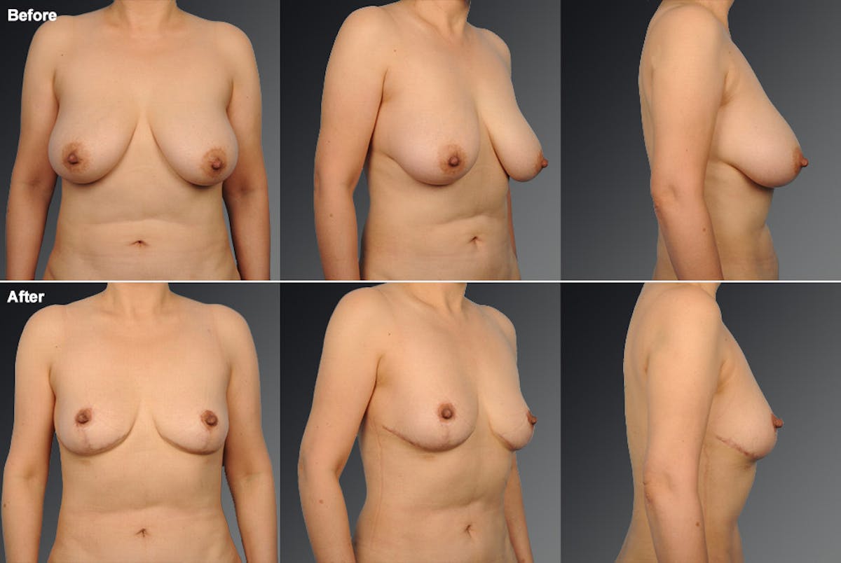Breast Reduction Before & After Gallery - Patient 105470138 - Image 1