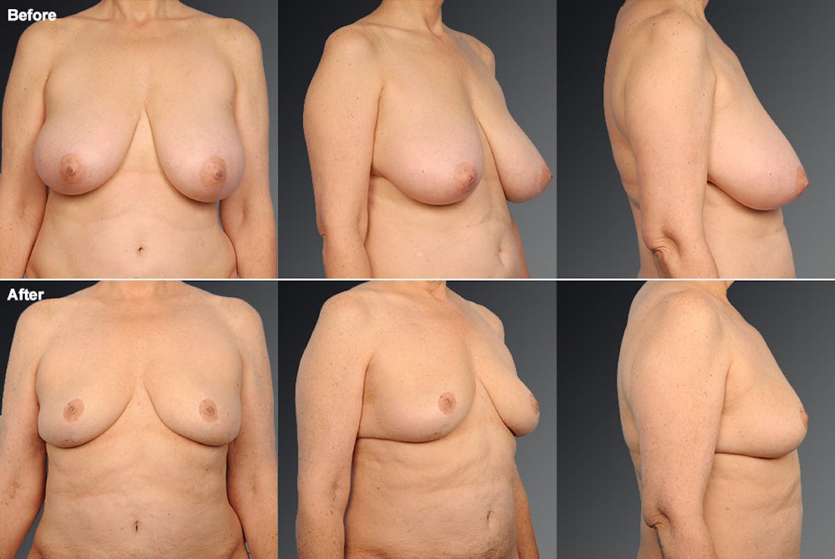 Breast Reduction Before & After Gallery - Patient 105470139 - Image 1