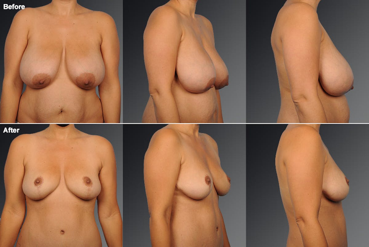 Breast Reduction Before & After Gallery - Patient 105472127 - Image 1