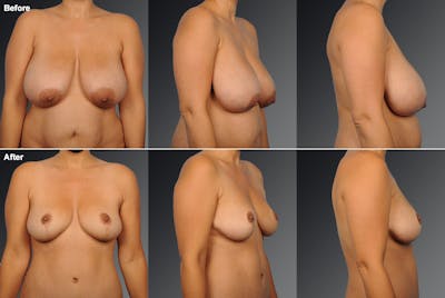 Breast Reduction Before & After Gallery - Patient 105472127 - Image 1