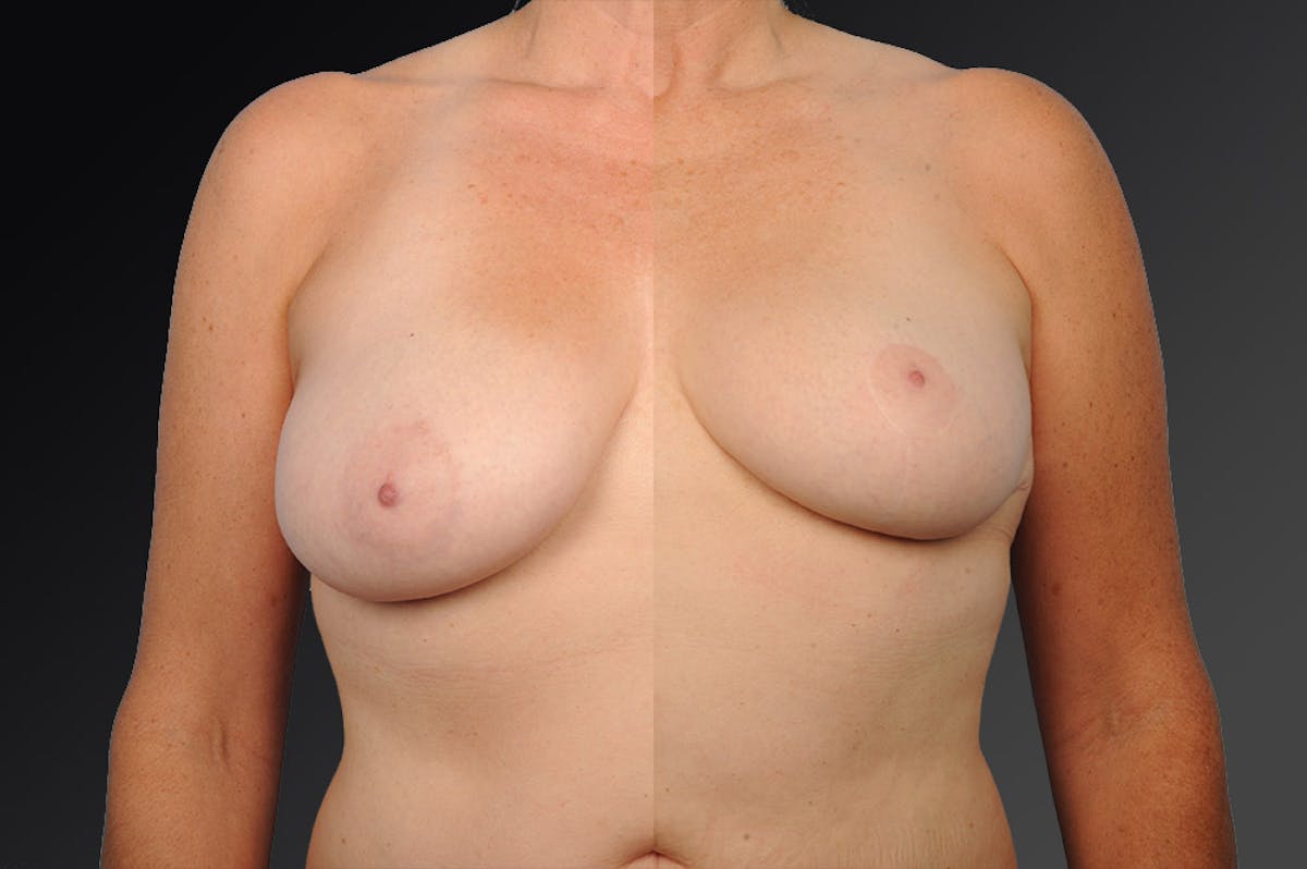 Breast Reduction Before & After Gallery - Patient 105472128 - Image 1