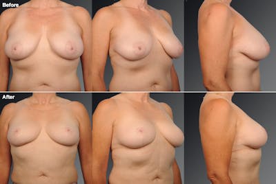 Breast Reduction Before & After Gallery - Patient 105472135 - Image 1