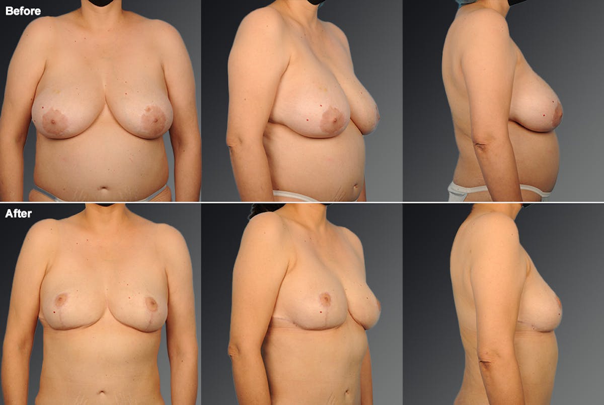 Breast Reduction Before & After Gallery - Patient 105472136 - Image 1
