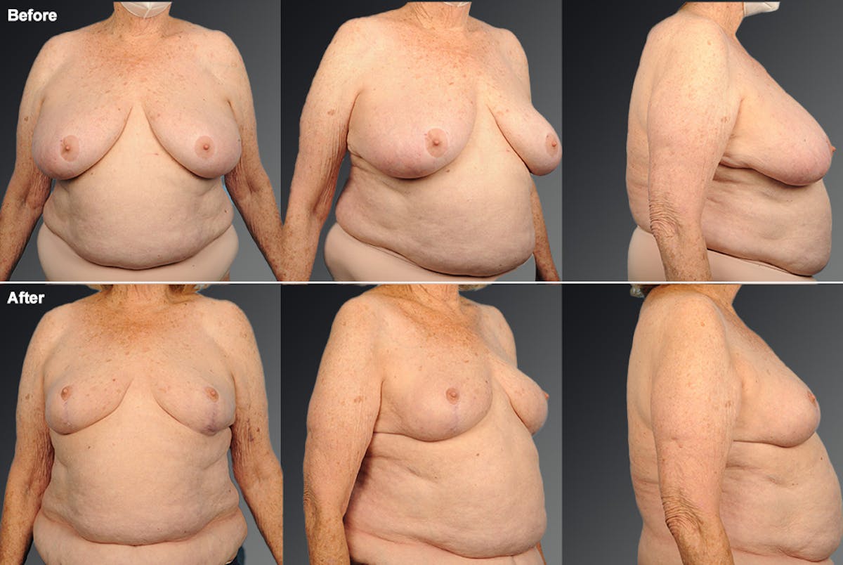 Breast Reduction Before & After Gallery - Patient 105472137 - Image 1