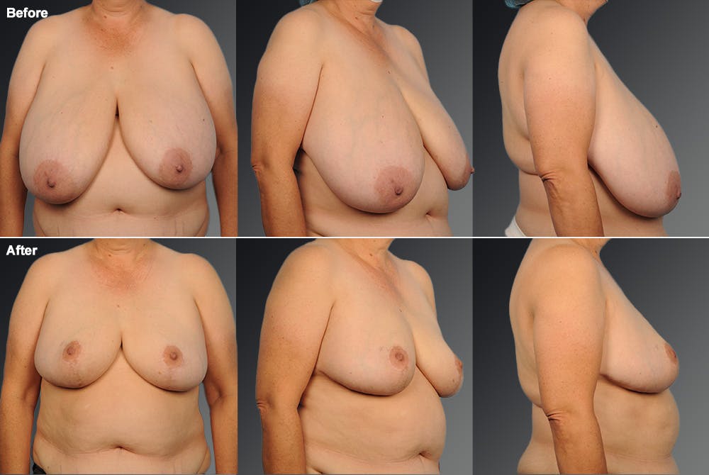 Breast Reduction Before & After Gallery - Patient 105472138 - Image 1