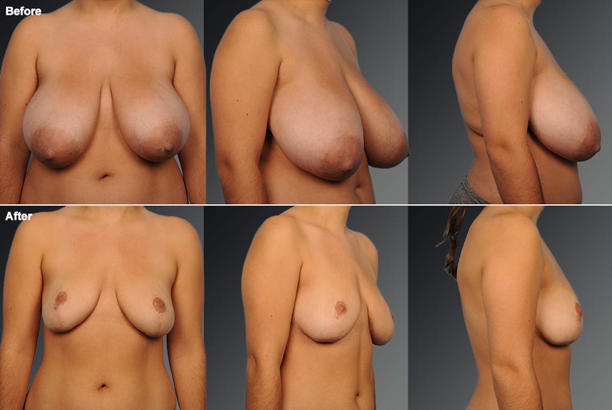 Breast Reduction Before & After Gallery - Patient 105472145 - Image 1