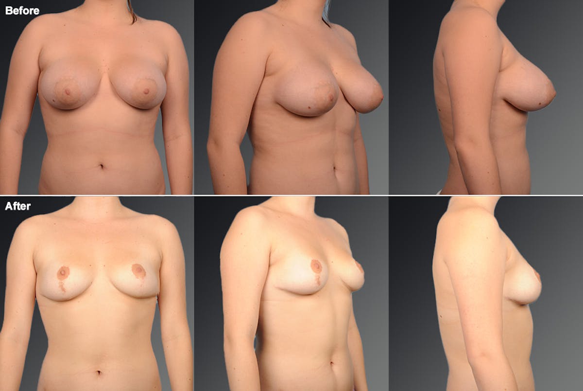 Breast Reduction Before & After Gallery - Patient 105474538 - Image 1