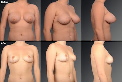 Breast Reduction Before & After Gallery - Patient 105474538 - Image 1