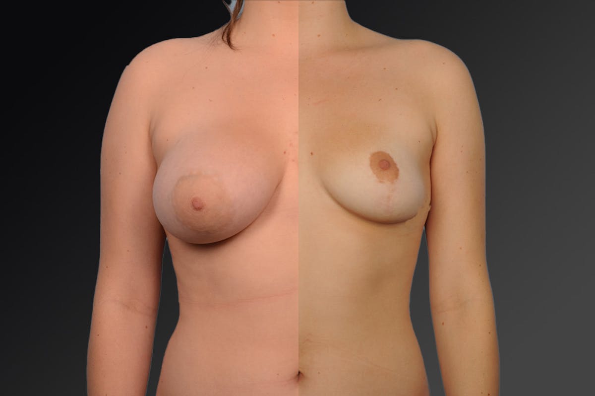 Breast Reduction Before & After Gallery - Patient 105474541 - Image 1