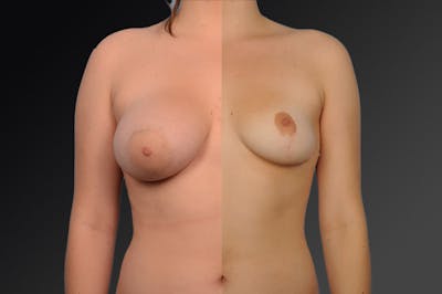 Breast Reduction Before & After Gallery - Patient 105474541 - Image 1