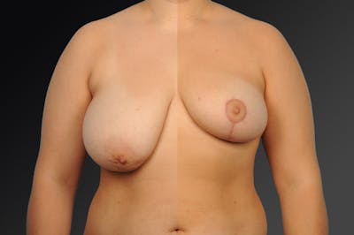 Breast Reduction Before & After Gallery - Patient 105474554 - Image 1
