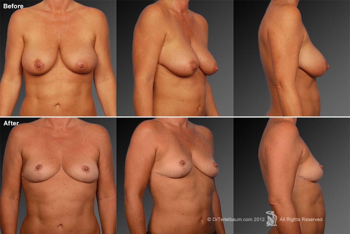 Breast Reduction Before & After Gallery - Patient 105474563 - Image 1
