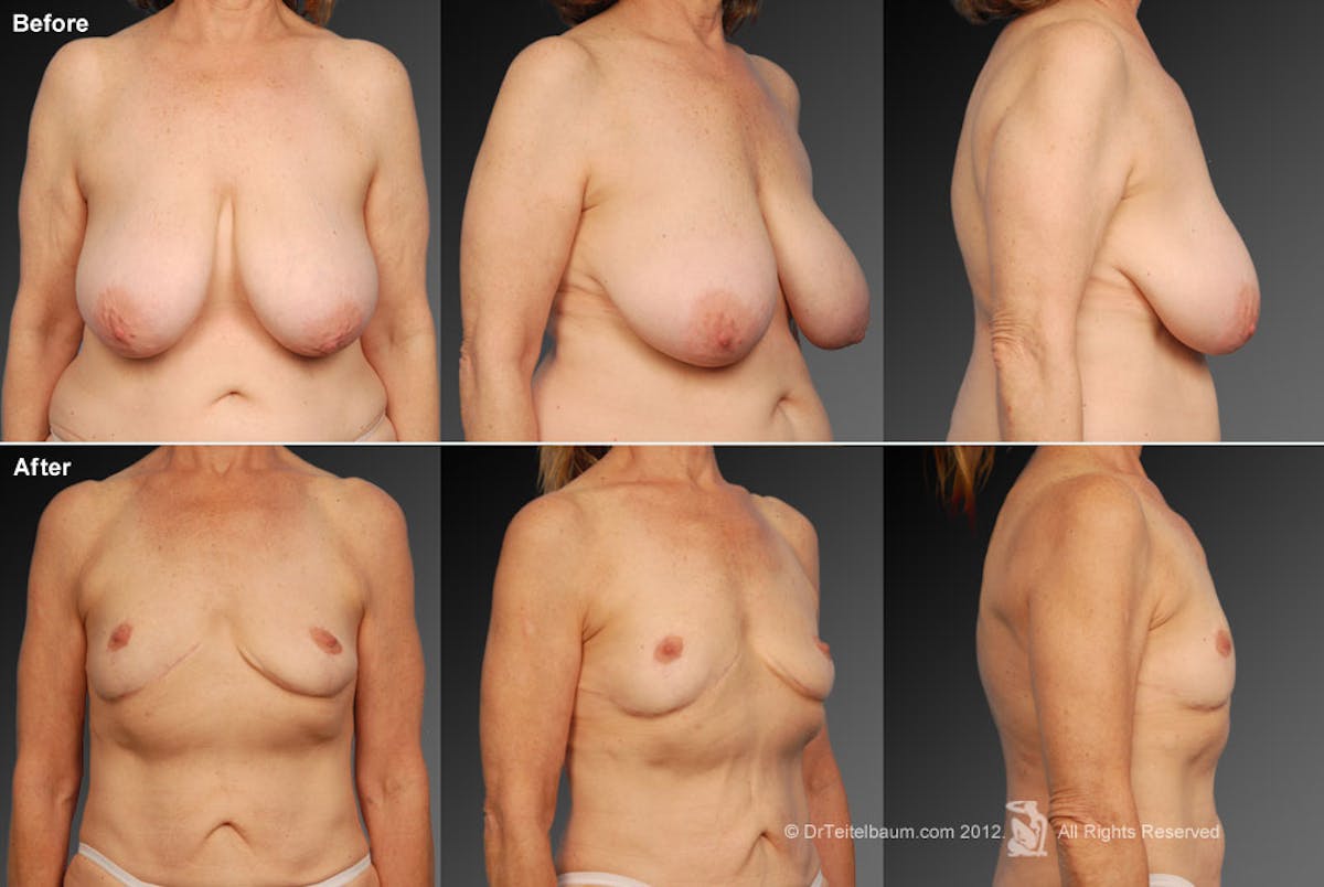 Breast Reduction Before & After Gallery - Patient 105474567 - Image 1