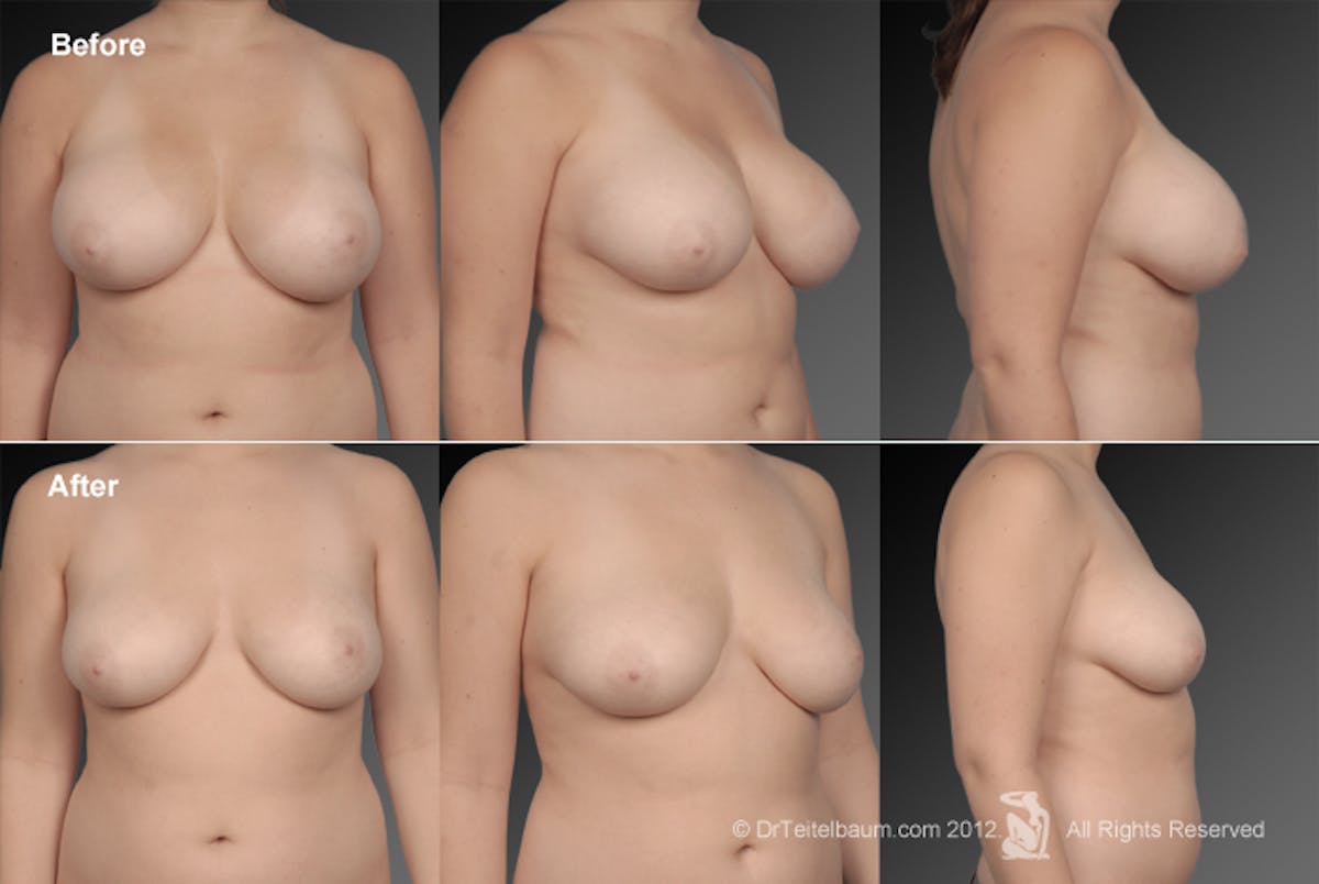 Breast Reduction Before & After Gallery - Patient 105474633 - Image 1