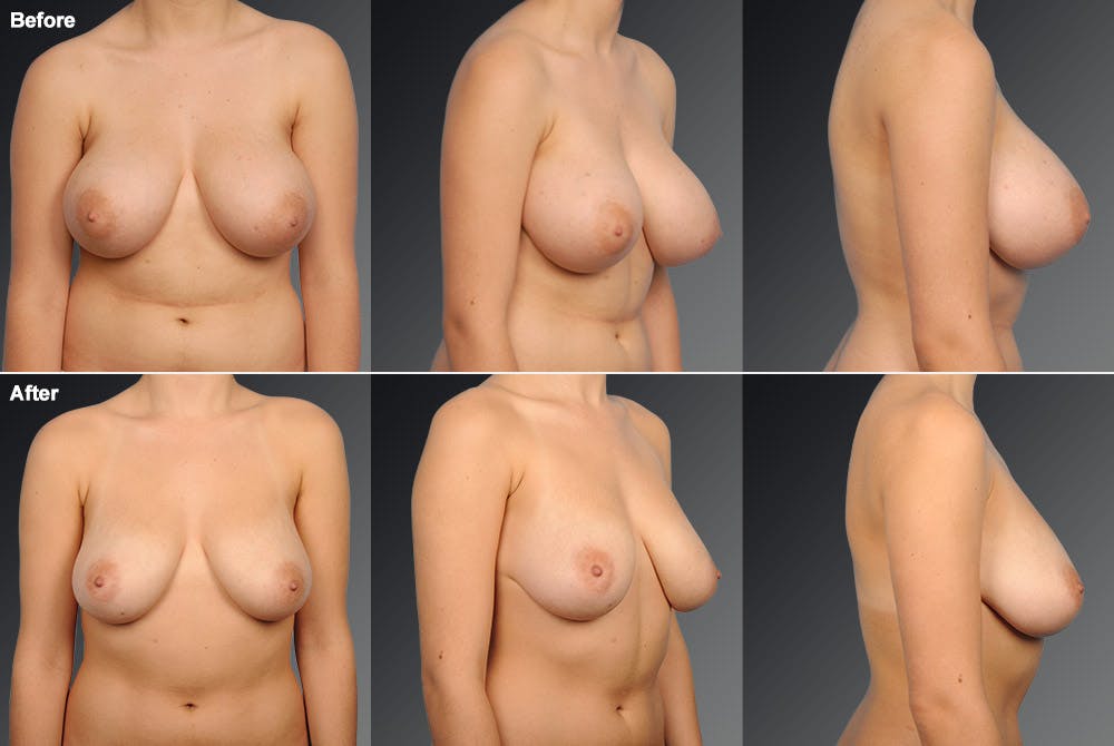 Breast Reduction Before & After Gallery - Patient 105474645 - Image 1