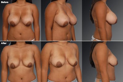 Breast Reduction Before & After Gallery - Patient 105474648 - Image 1