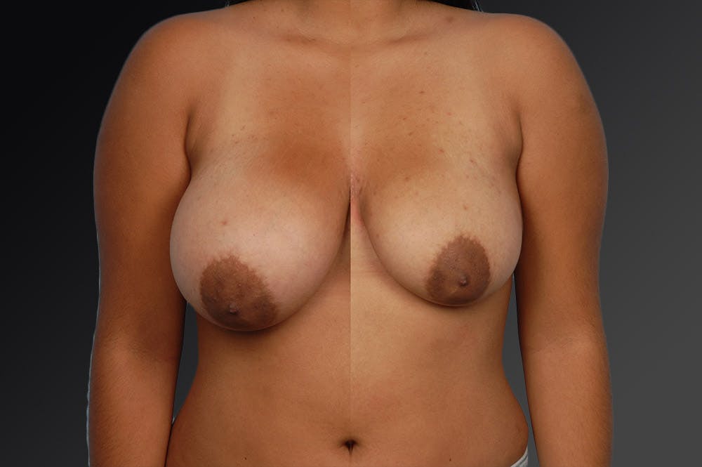 Breast Reduction Before & After Gallery - Patient 105474652 - Image 1