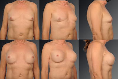 MTF Top Surgery/Transgender Before & After Gallery - Patient 105492548 - Image 1
