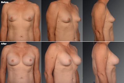 MTF Top Surgery/Transgender Before & After Gallery - Patient 105492552 - Image 1