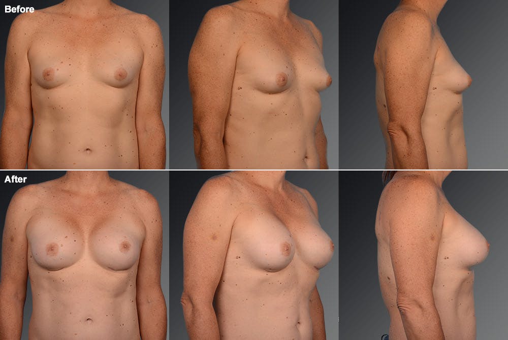 MTF Top Surgery/Transgender Before & After Gallery - Patient 105492552 - Image 1