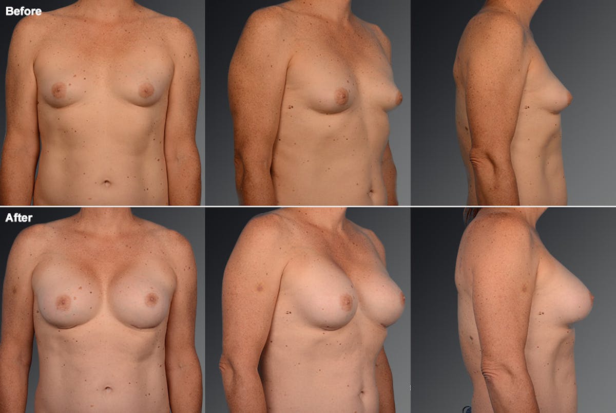 MTF Top Surgery/Transgender Before & After Gallery - Patient 105492552 - Image 1
